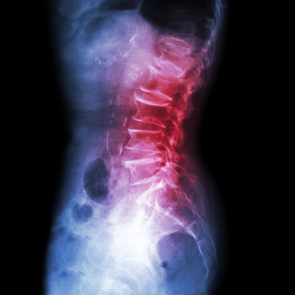 spondylosis